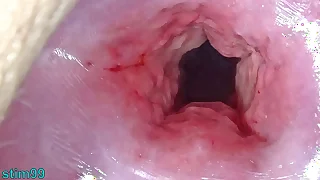Stacked Japanese Cervix Stretching increased by Uterus Dilation with Penetration